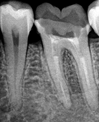 dental_canals